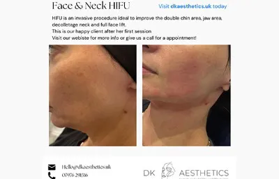 Before and After Face and Neck Treatment