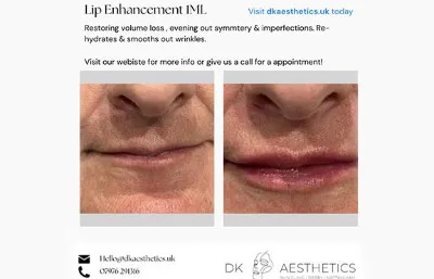 Before and after Lip enhancement treatment