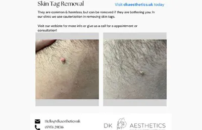 Before and After Skin Tag Removal Treatment