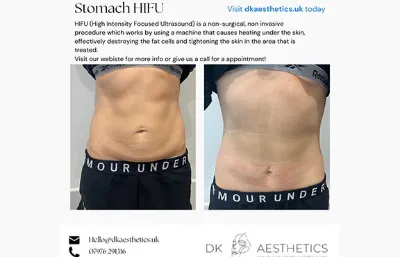 Before and after stomach HIFU treatment