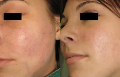 Before and after laser peel treatment
