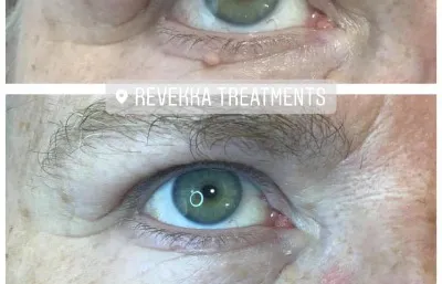 Before and after skin tag removal treatment