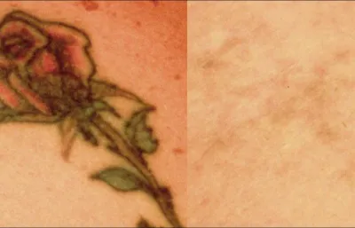 Before and after tattoo removal treatment