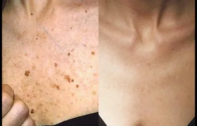 Pigmentation treatment before and after