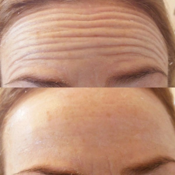 Forehead lines treated with botox