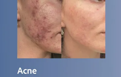 Before and after Acne treatment