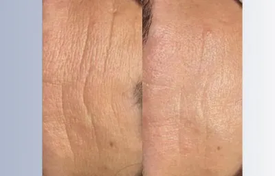 Before and after Lines and wrinkle treatment