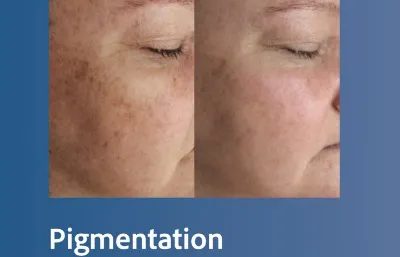 Before and after Pigmentation treatment