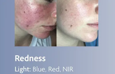 Before and after skin rejuvenation treatment