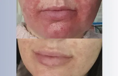 Pigmentation treatment before and after