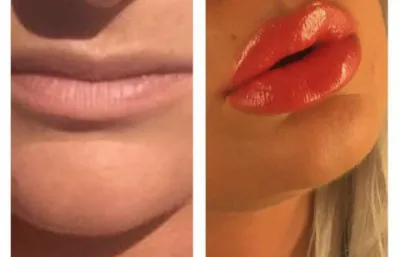 Before and after lip filler treatment