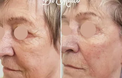 Before and after Non surgical face lift with threads treatment
