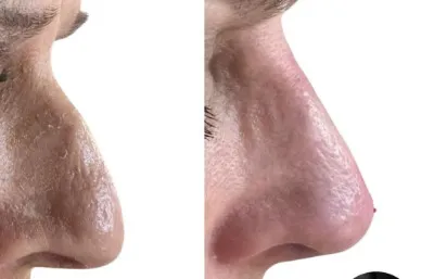 Before and after nose reshaping treatment