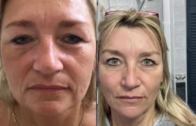 Before and after skin rejuvenation treatment