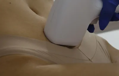 Laser hair removal