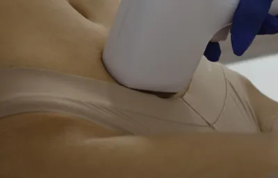 Hair removal Laser treatment