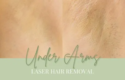 Laser hair removal treatment