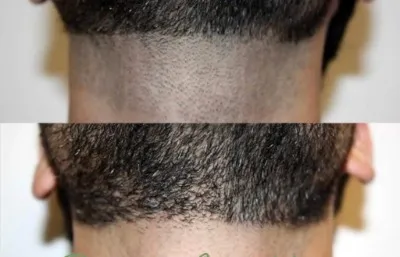 Laser hair removal treatment before and after