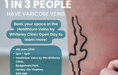 Varicose Vein treatment