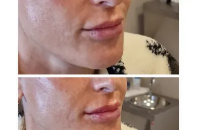 Lip filler treatment