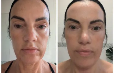 One post CO2 Laser treatment face and neck.  Photo