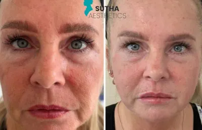 Before and after Collagen Thread Lift treatment