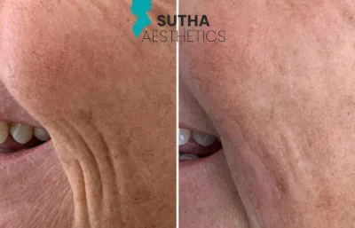 Before and after dermal filler treatment