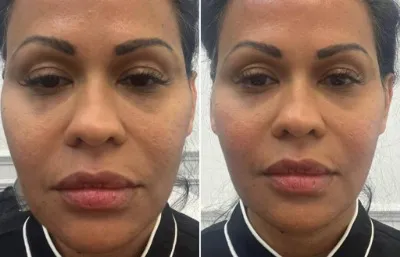 Before and after EMFACE non invasive facial contouring treatment