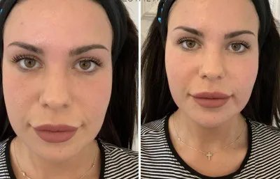 Before and after facial dermal filler treatment