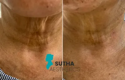 Before and after Sculptra treatment