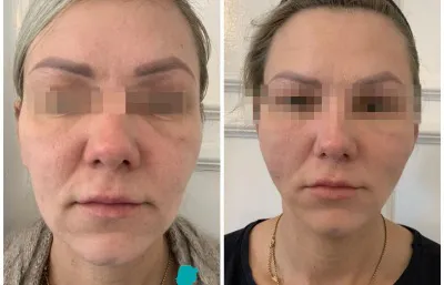 Before and after Thread Lift treatment