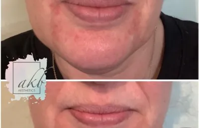 Lip augmentation