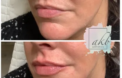 Lip filler before and after