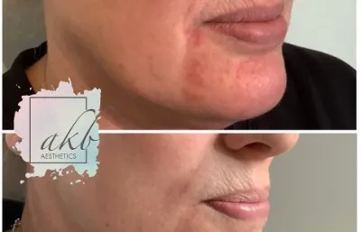 Lip filler treatment