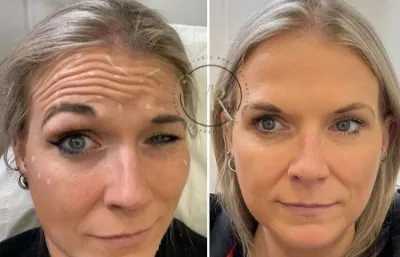 Before and after rejuvenation treatment