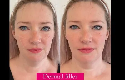 Before and after Dermal filler treatment