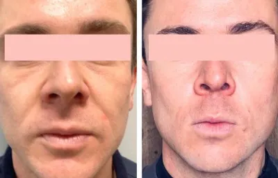 Before and after facial rejuvenation treatment