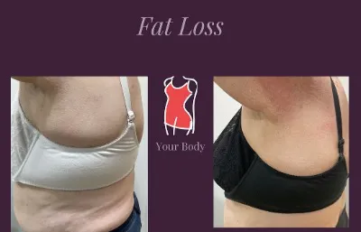 Before and after fat loss treatment
