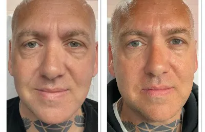 Before and after mid face thread lift treatment