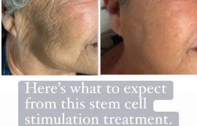 Before and after Polynucleotides treatment