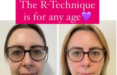 The R-technique treatment