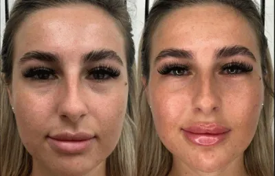Before and after lip augmentation treatment