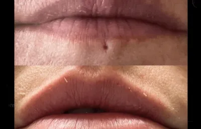 Before and After Lip Rejuvenation