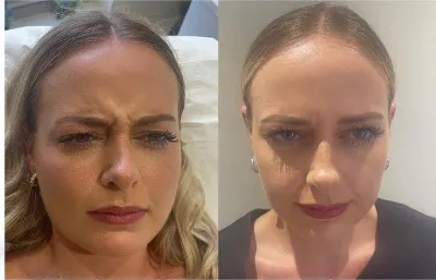Before and after forehead lines treatment