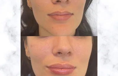 Before and after Lip treatment