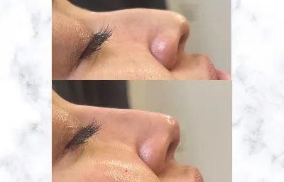 Before and after nose reshaping treatment