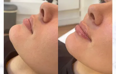 Lip augmentation treatment before and after