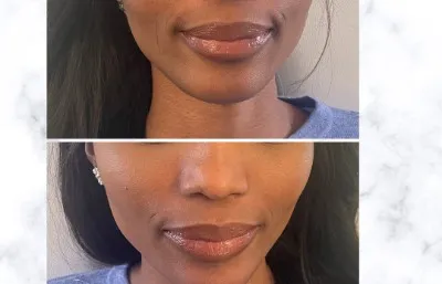 Lip volumising treatment before and after