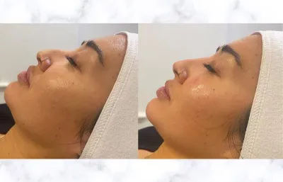 Skin rejuvenation treatment before and after
