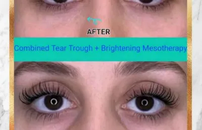 Tear trough treat before and after